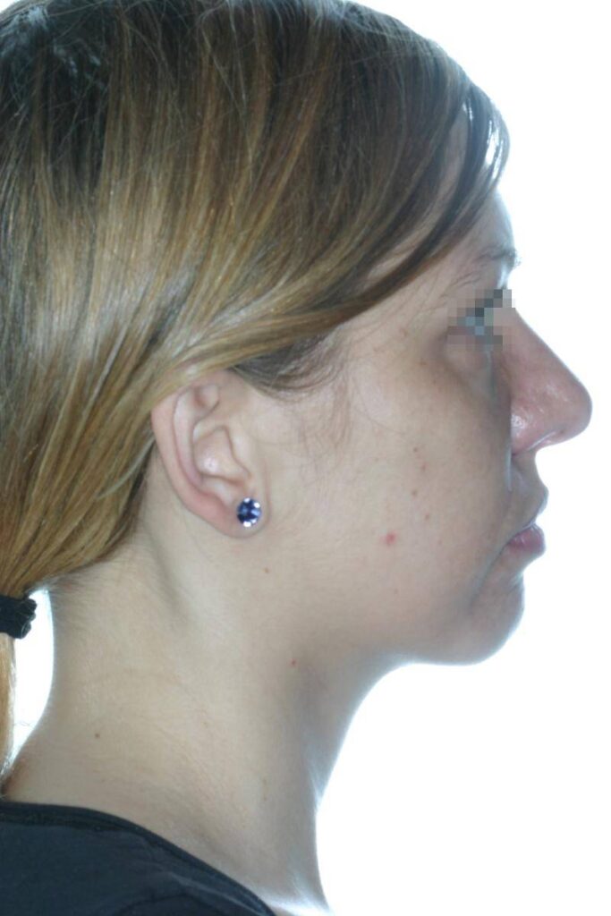 Caso Clínico Rinoplastia