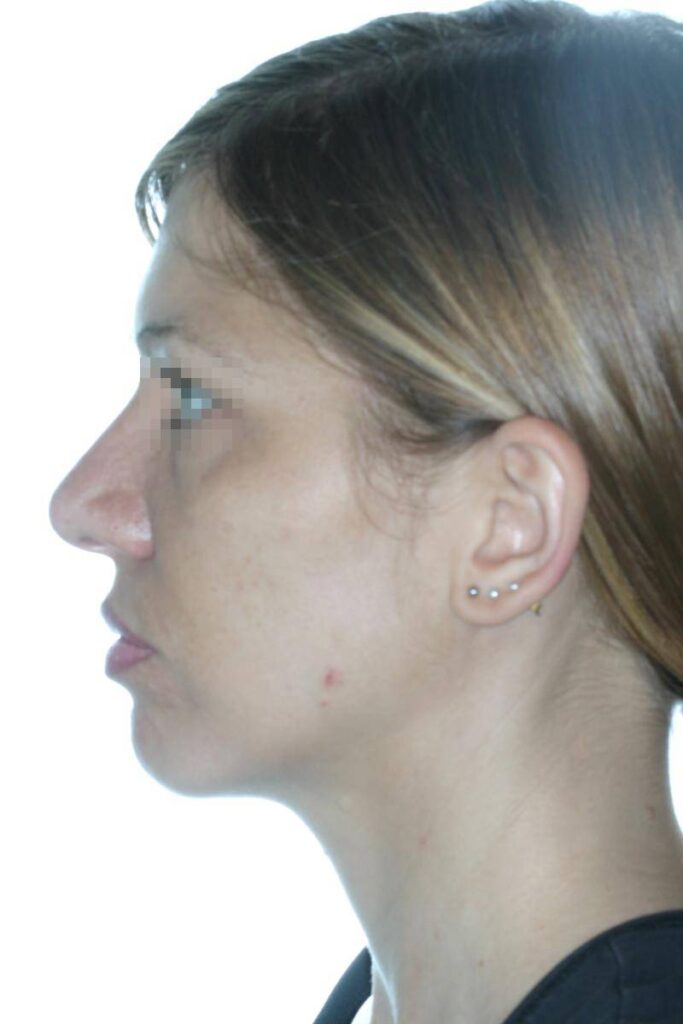 Caso Clínico Rinoplastia