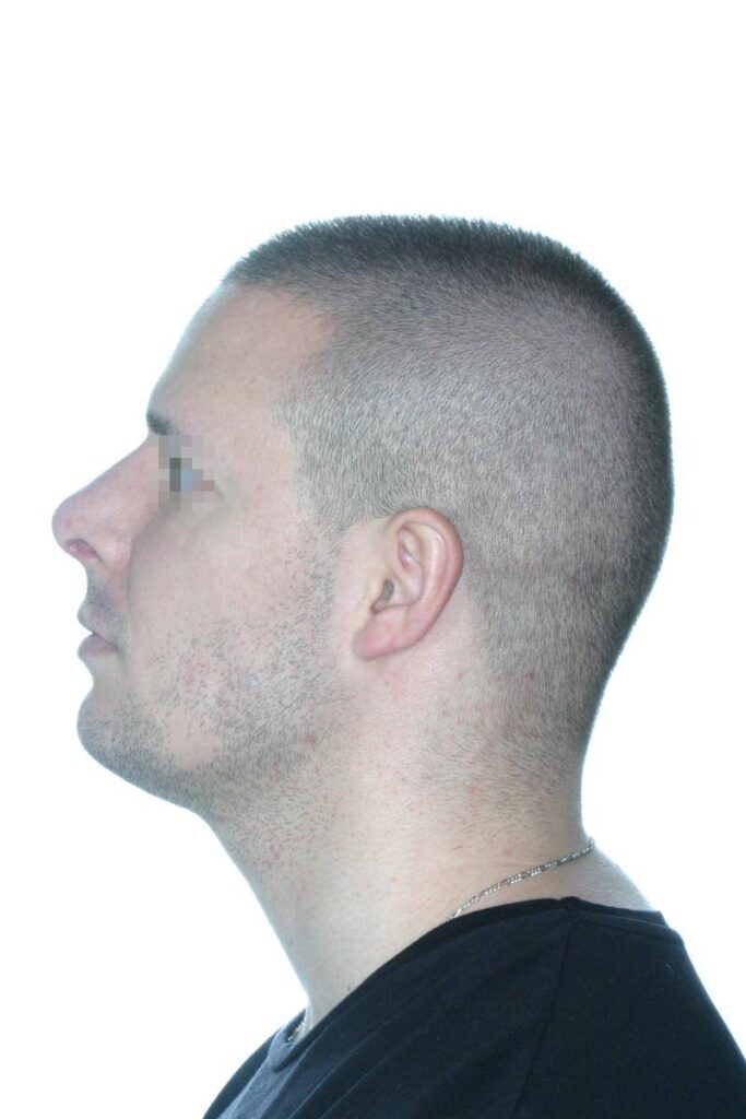 Caso Clínico Rinoplastia