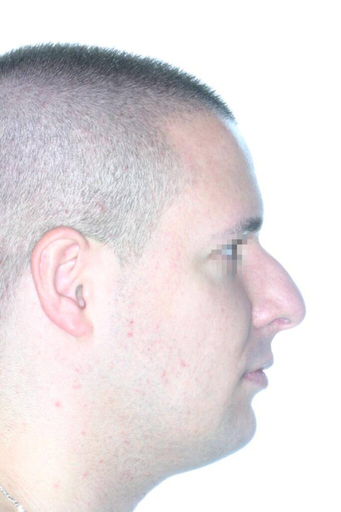 Caso Clínico Rinoplastia
