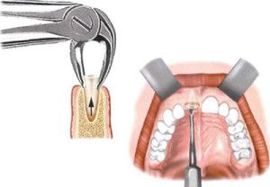 extracciones dentales