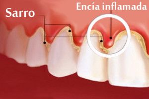 Gingivitis1