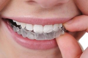 Invisalign i7