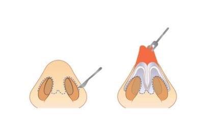 rinoplastia abierta