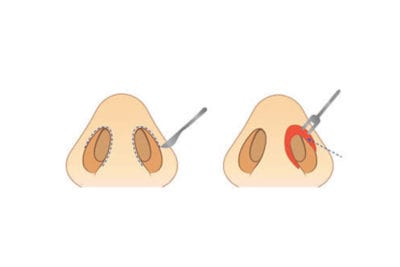 rinoplastia cerrada