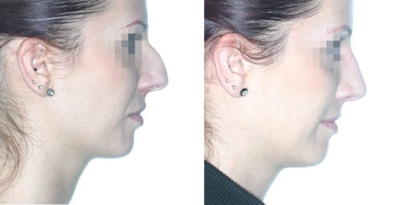 Rinoplastia cerrada. Antes y después