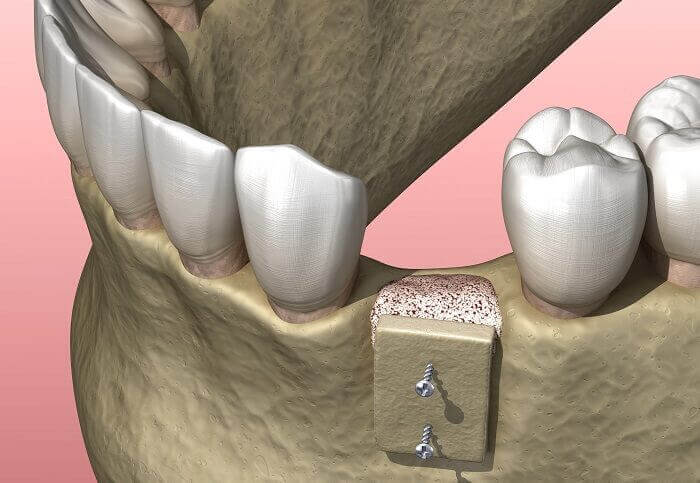 Injerto de hueso dental en Barcelona