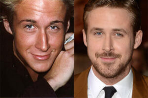 Ryan Gosling (Fuente imagen: faceaestheticsturkey.co)