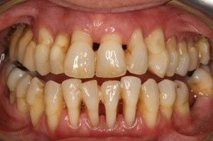 Periodontitis