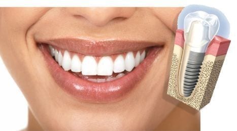 Implantes dentales carga inmediata