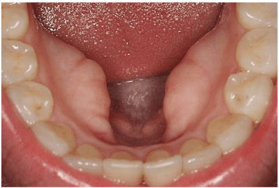 ¿Qué son los torus mandibulares?
