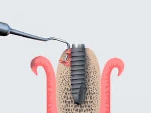 Tractament d'implant