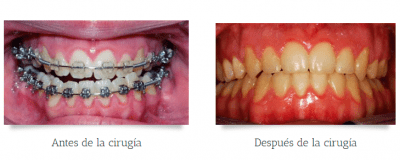 Caso de prognatismo mandibular