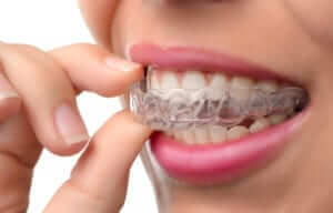 Estética dental - ATM y el Bruxismo