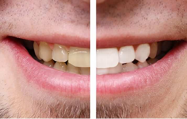 Estética dental - Blanqueamiento dental