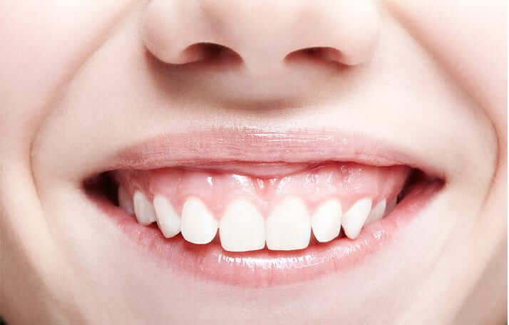 Estética dental - Sonrisa gingival