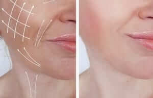 Cirugía estética facial - Lifting facial