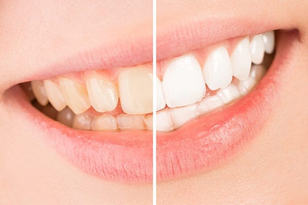 Blanqueamiento dental para una sonrisa blanca y brillante