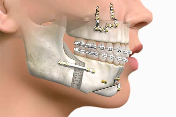 Prognatismo Mandibular o Clase 3 » Cirugía Ortognática - Instituto