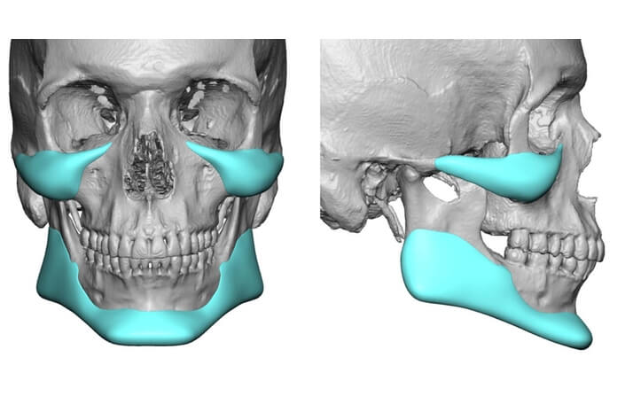 Implantes faciales Clínica Birbe