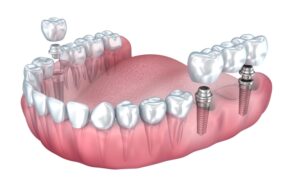 Implantes dentales - Clínica Birbe Barcelona