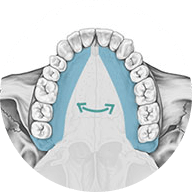 Paladar estrecho con Invisalign