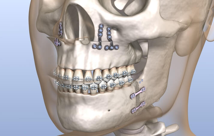 Ortodoncia quirúrgica en Barcelona