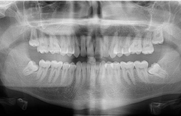 Tratamiento de dientes incluidos y cordales - Clínica Birbe