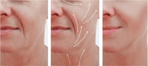 Lifting facial en Barcelona