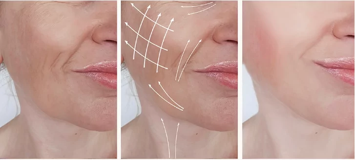 Lifting du visage  Barcelone : traitement de rajeunissement facial