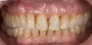 Rejuvenecimiento dental antes