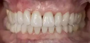 Rejuvenecimiento dental después