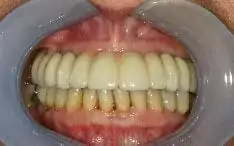 Aspecto prótesis dental colocada