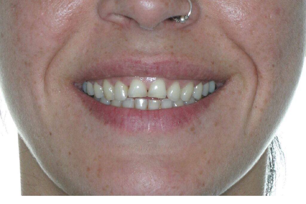 Caso clínico carillas dentales