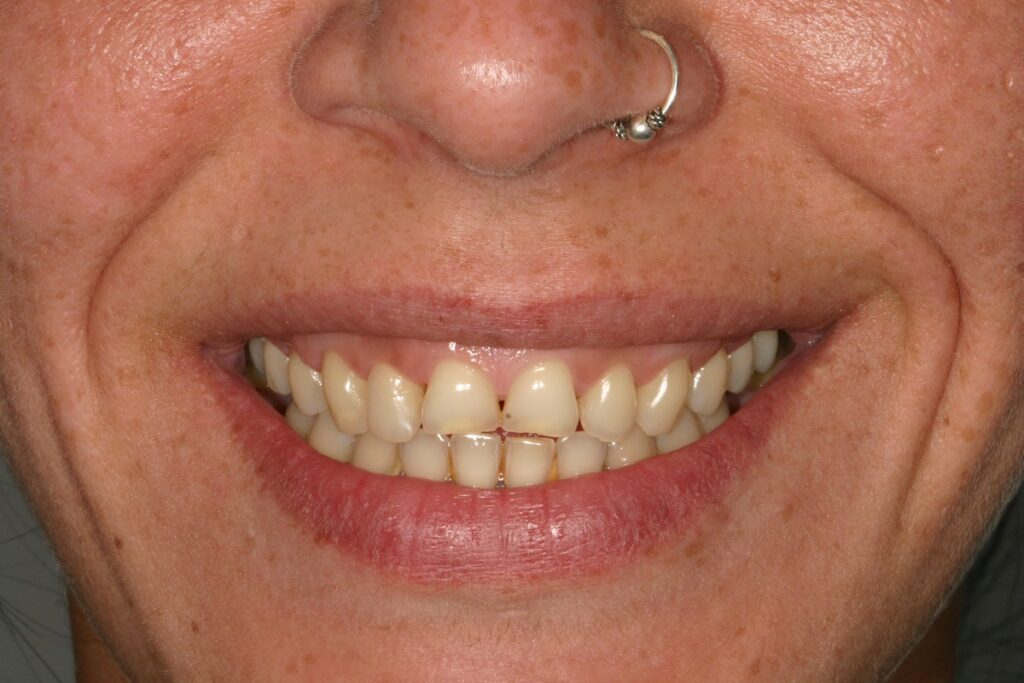 Caso clínico carillas dentales