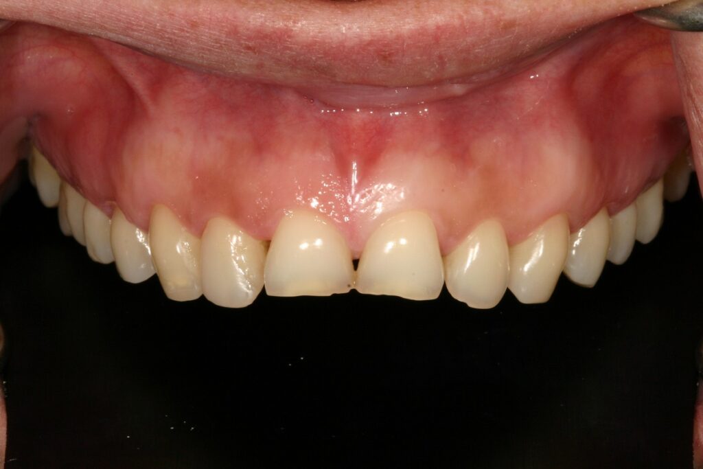 Caso clínico carillas dentales