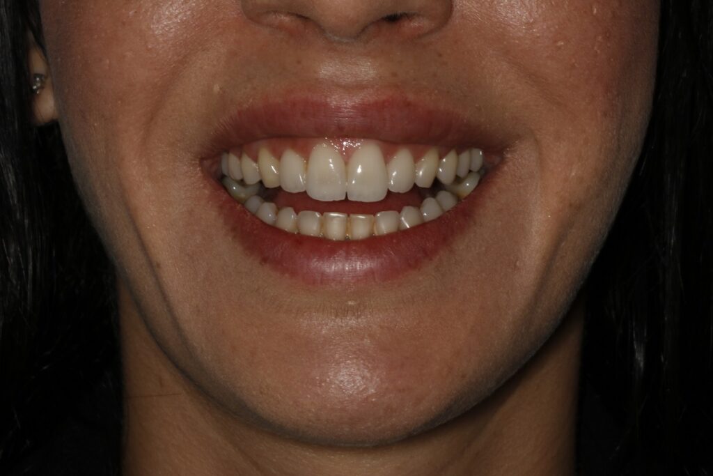 Caso clínico carillas dentales