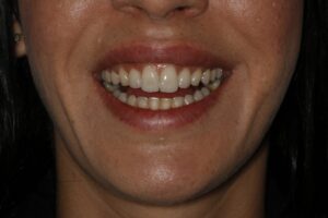 Caso clínico carillas dentales