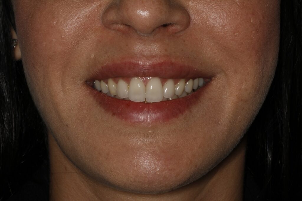 Caso clínico carillas dentales