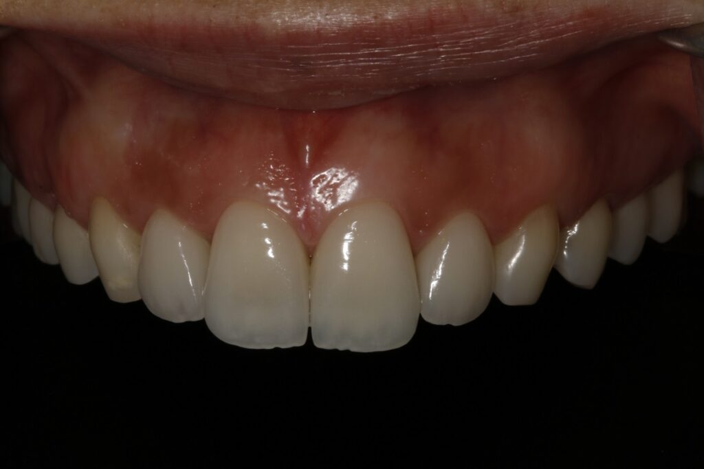 Caso clínico carillas dentales