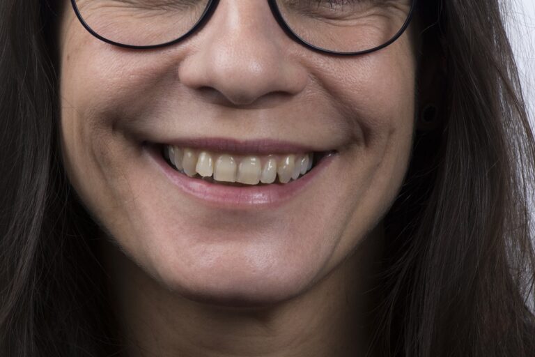 Caso clínico carillas dentales