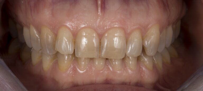 Caso clínico carillas dentales