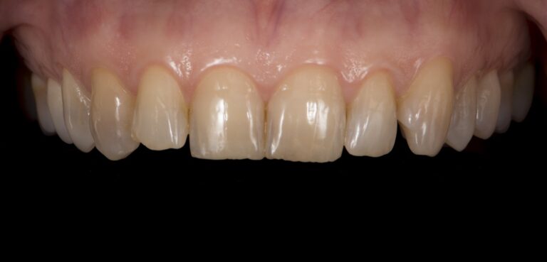 Caso clínico carillas dentales