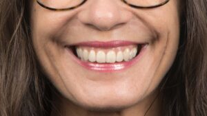 Caso clínico carillas dentales