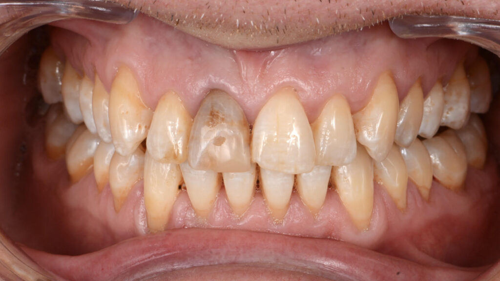 Caso clínico carillas dentales