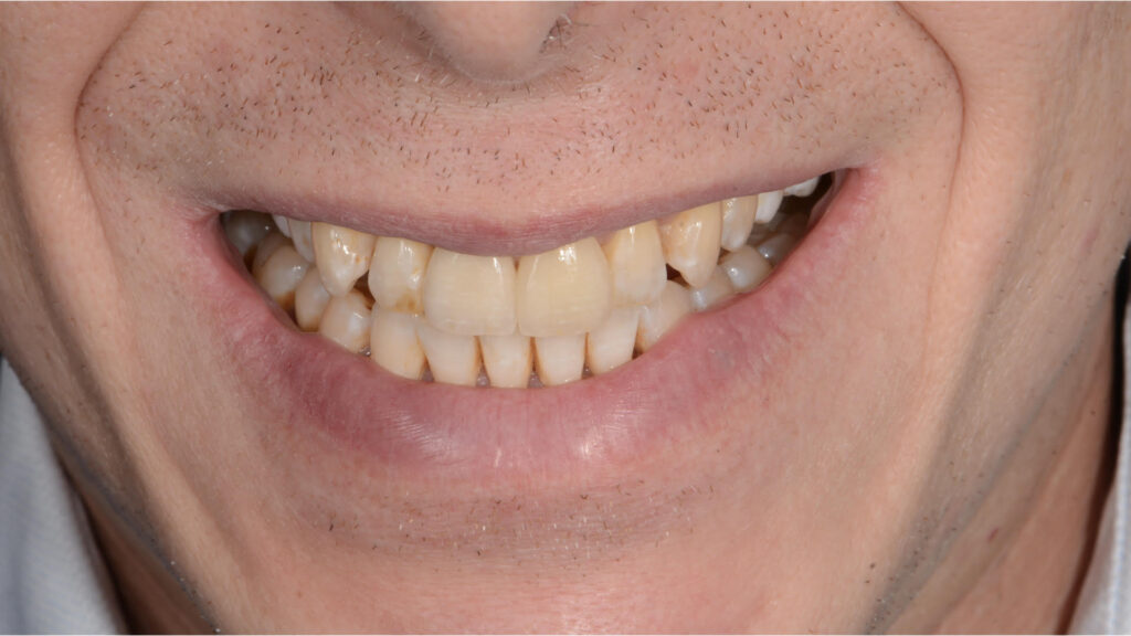 Caso clínico carillas dentales