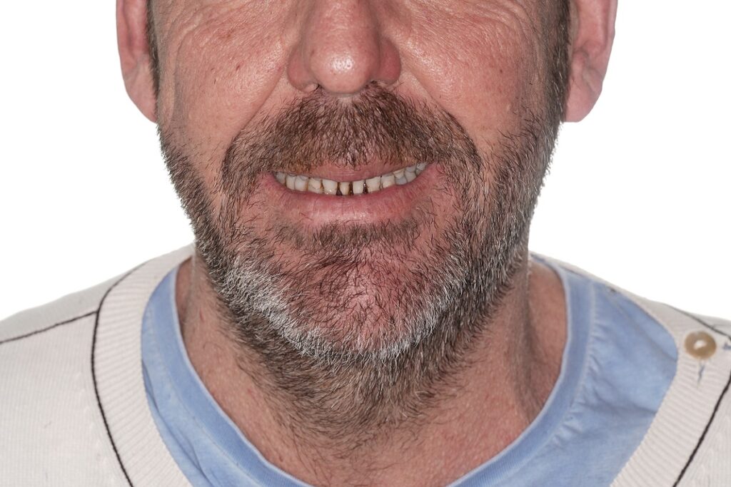 Caso clínico carillas dentales