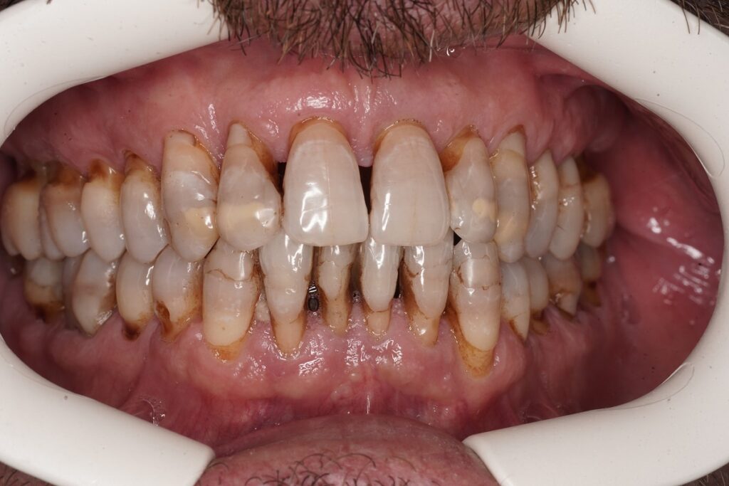 Caso clínico carillas dentales