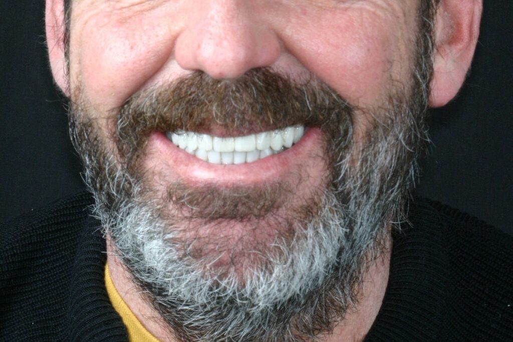 Caso clínico carillas dentales