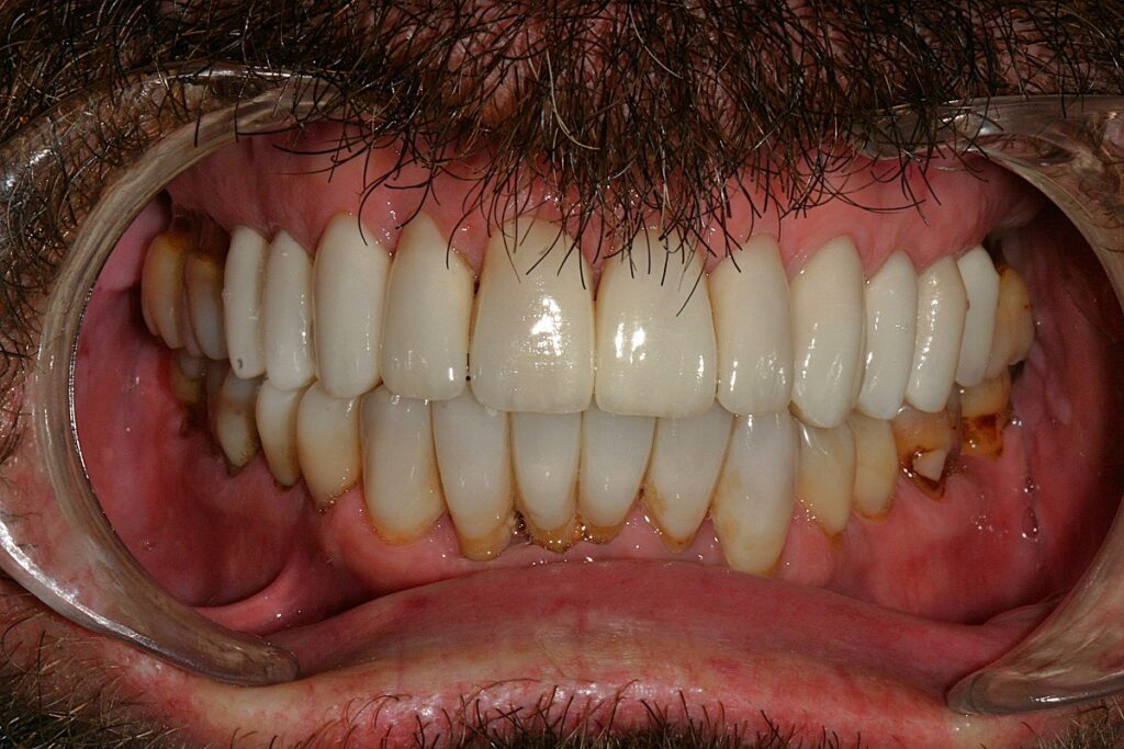 Caso clínico carillas dentales